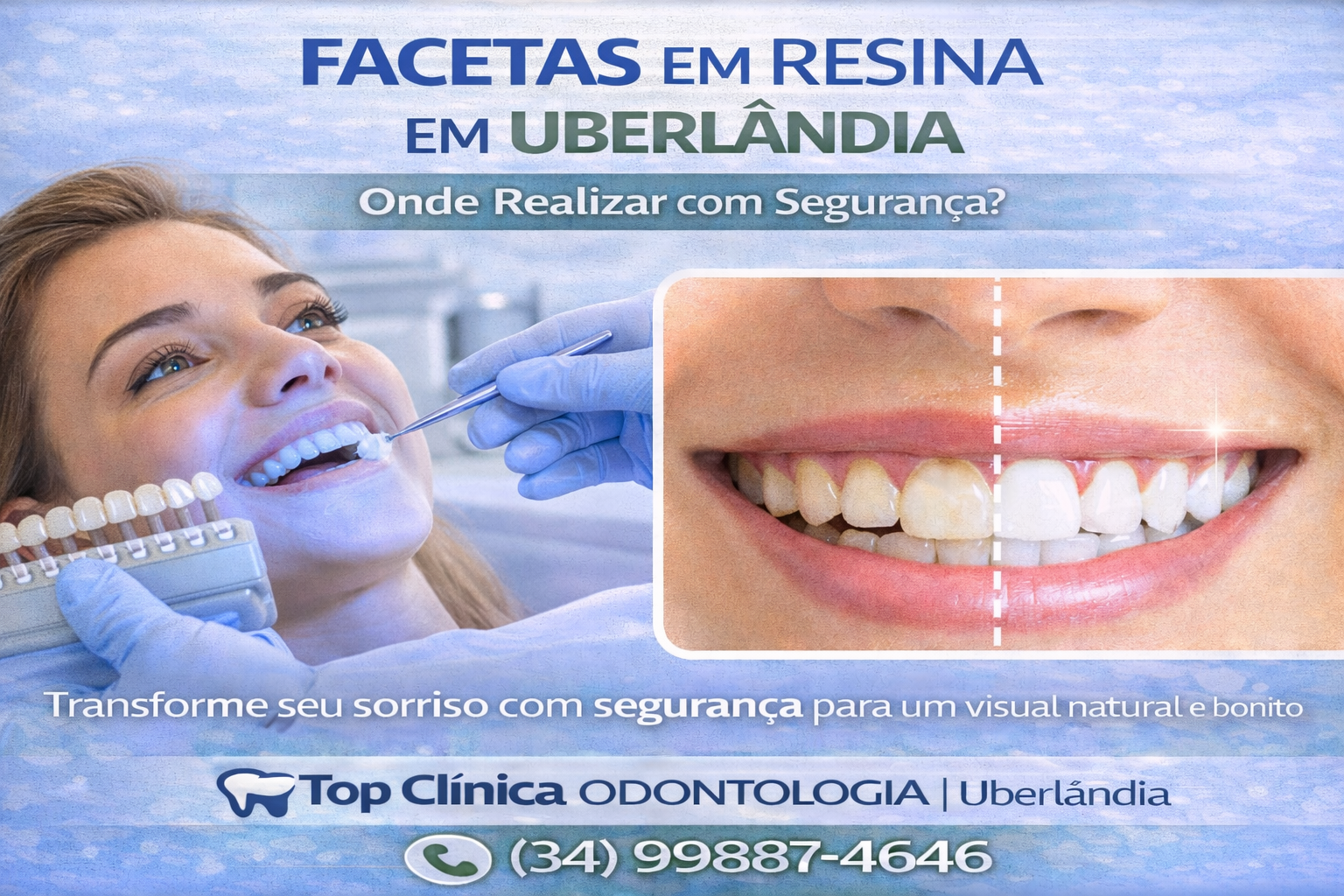 Facetas em resina em Uberlândia realizadas com segurança na Top Clínica Odontologia